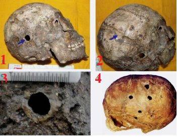 древние медицинские операции на черепах 