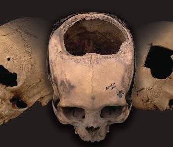  Древние инки делали трепанацию черепа 